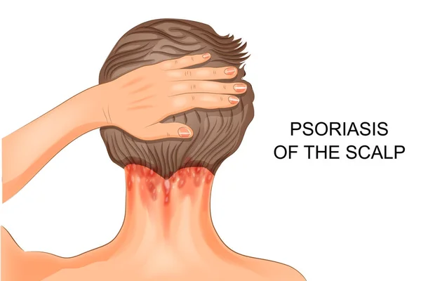 Psoriasis del cuero cabelludo — Vector de stock