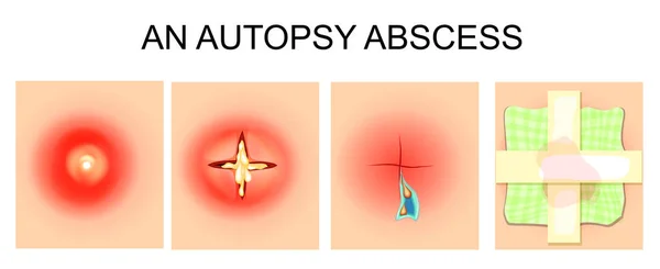 Un abcès de l’autopsie — Image vectorielle