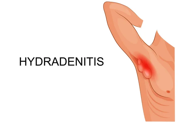 Hidroadenite. inflamação das glândulas sudoríparas . —  Vetores de Stock
