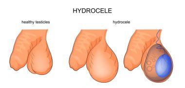 Hidrosel. Üroloji
