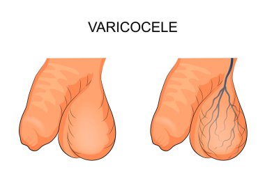 Testis testis, etkilenen Varikosel içinde