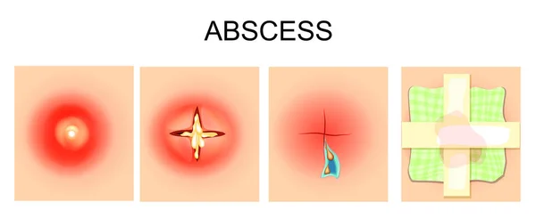 Abcès, furoncle, autopsie, pansement — Image vectorielle