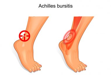 the foot is affected by Achilles bursitis clipart
