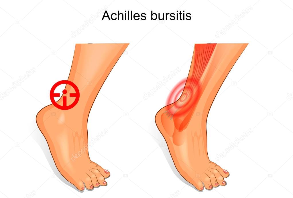 the foot is affected by Achilles bursitis