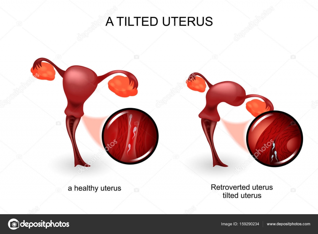 A tilted uterus. gynecology Stock Vector Image by A tilted uterus. gynecology Stock Vector Image by