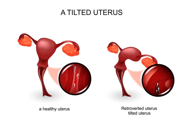 Un utérus incliné. gynécologie — Image vectorielle