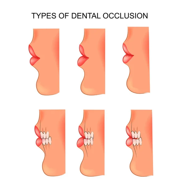 Bite dental. dentistry — Stock Vector