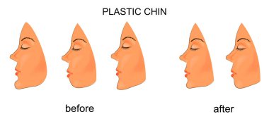 plastic chin. surgery clipart