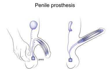 penile prosthesis. urology clipart