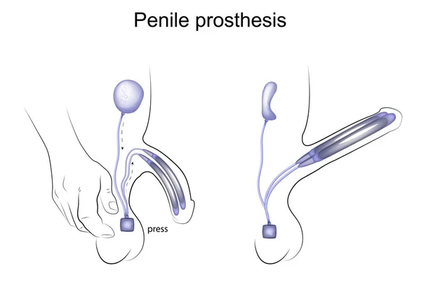 Prothèse pénienne. urologie — Image vectorielle