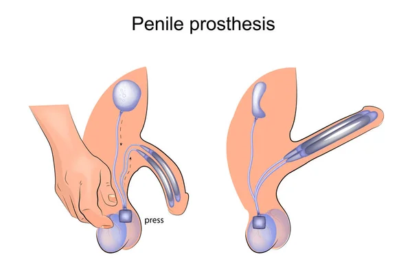 Protezy prącia. Urologia — Wektor stockowy