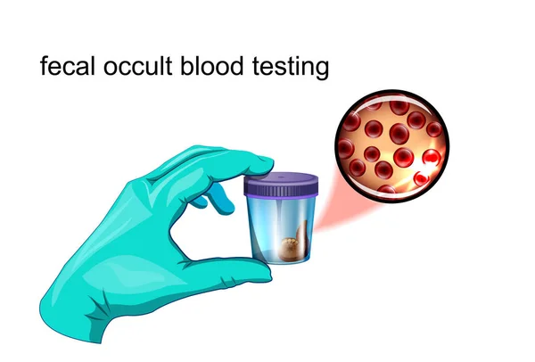 Analyse de sang occulte fécale — Image vectorielle