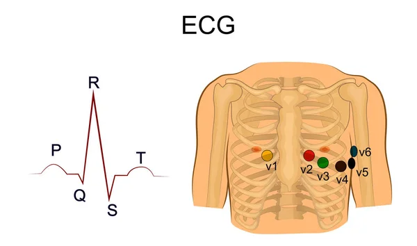 Électrocardiogramme. Poitrine mène — Image vectorielle