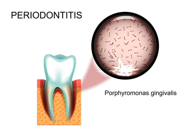 Parodontitis. Porphyromonas gingivalis — Stockvector