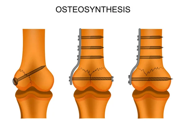 Osteosíntesis del fémur — Archivo Imágenes Vectoriales