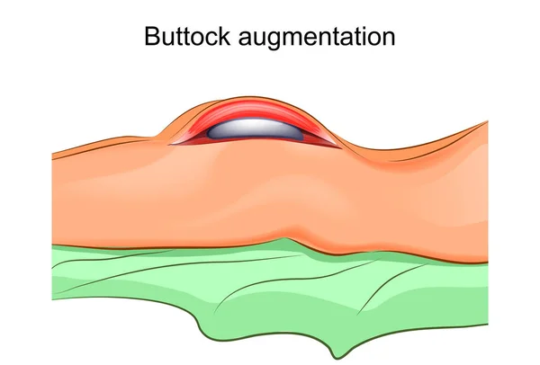 Gluteoplasty. plasztikai sebészet — Stock Vector