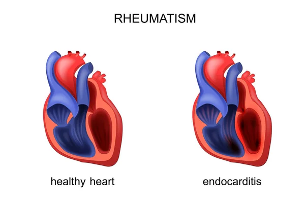 Hjärtat friskt som sjukt tillstånd endokardit — Stock vektor