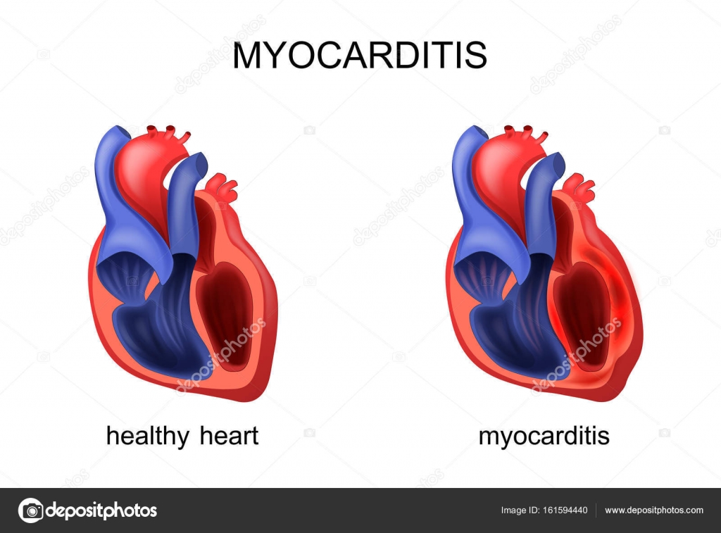 miocarditis de corazón sano y enfermo — Vector de stock © Artemida-psy ...
