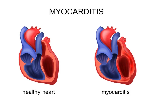 Herz gesunde und kranke Myokarditis — Stockvektor