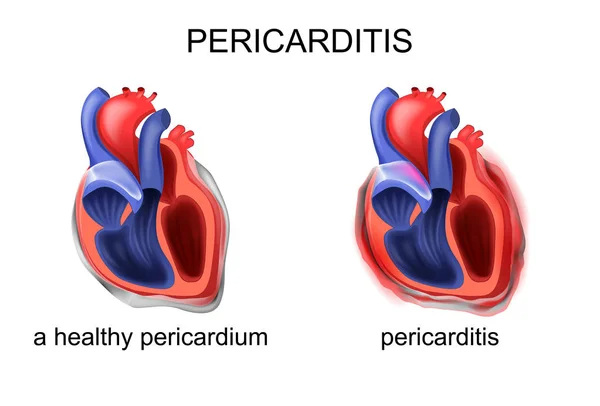 Un pericardio sano, pericarditis — Vector de stock
