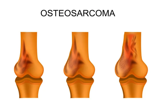 El hueso del muslo afectado por el osteosarcoma — Archivo Imágenes Vectoriales