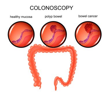 polyp of the large intestine and cancer clipart