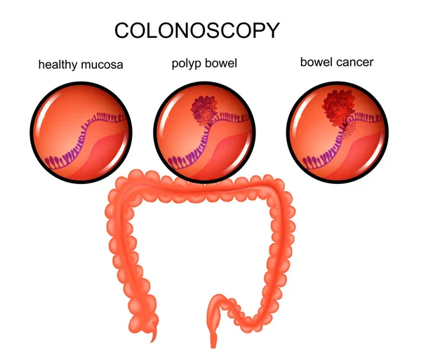 Pólipo do intestino grosso e câncer —  Vetores de Stock