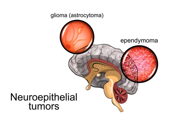 Hjärntumör 2, neurokirurgi — Stock vektor