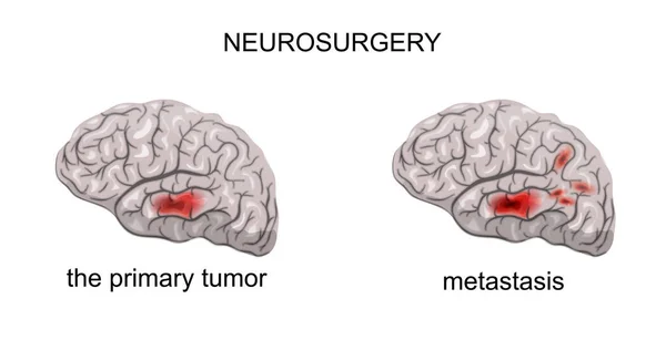 Опухоль головного мозга, нейрохирургия — стоковый вектор