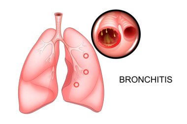 bronşit ile etkilenen akciğerler,