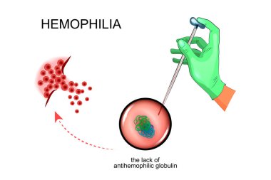 Hemofili patolojik sürecinde