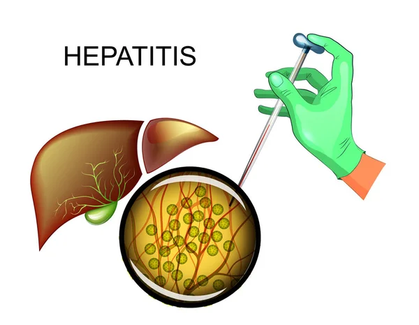 Análisis de hepatitis C y enfermedad hepática — Vector de stock