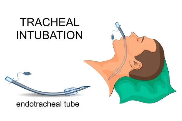 Intubálás a légcső. mesterséges szellőzés a tüdő — Stock Vector