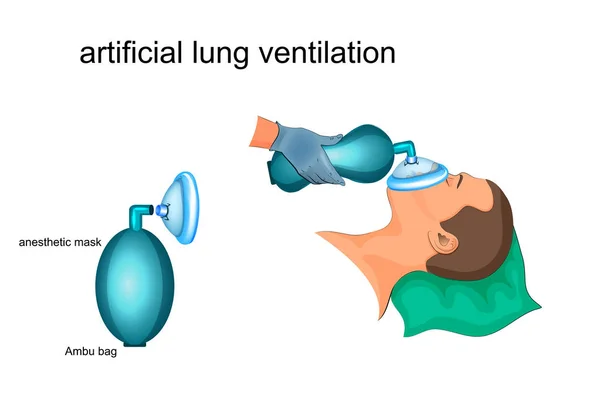 Künstliche Beatmung der Lunge — Stockvektor