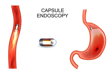capsule endoscopy. EGD, gastroenterology. clipart
