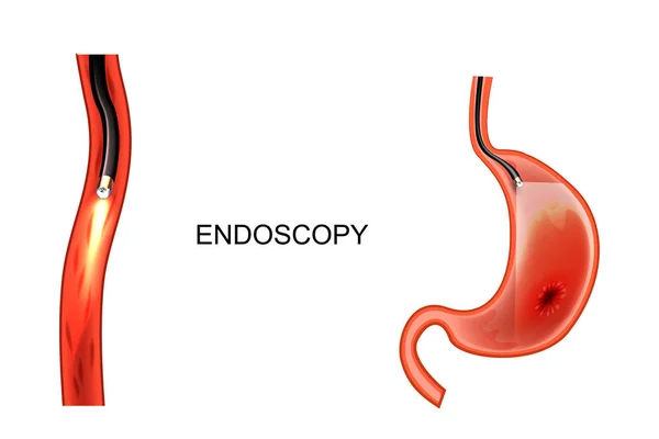 Endoscopy of the stomach. EGD. ulcer, cancer — Stock Vector
