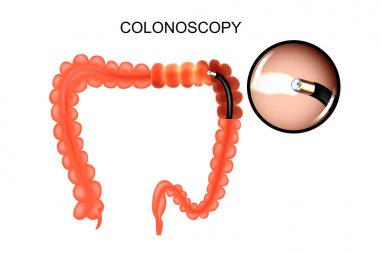the colon, colonoscopy clipart
