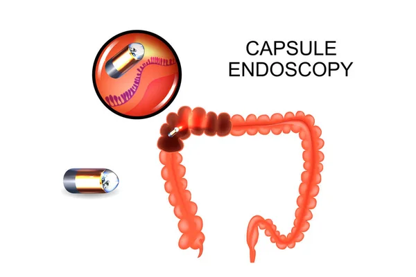 Capsule-endoscopie van de dikke darm — Stockvector