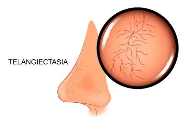 teleangiectasia, the dilation of blood vessels on the nose clipart