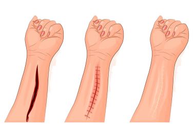 the stitched wound of the hand clipart