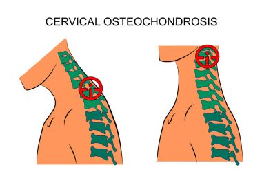 cervical osteochondrosis. traumatology clipart