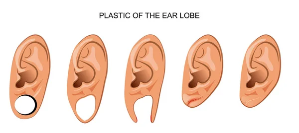 Plastic ear after ear tunnel — Stock Vector