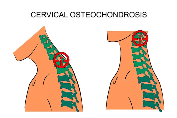 Osteocondrose cervical. traumatologia —  Vetores de Stock