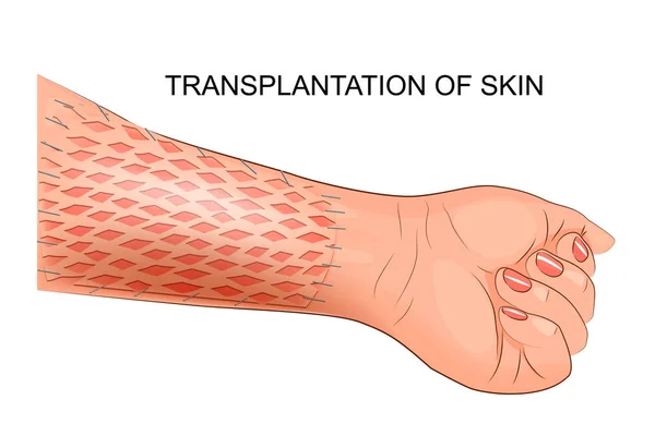 Transplante de pele. cirurgia plástica —  Vetores de Stock