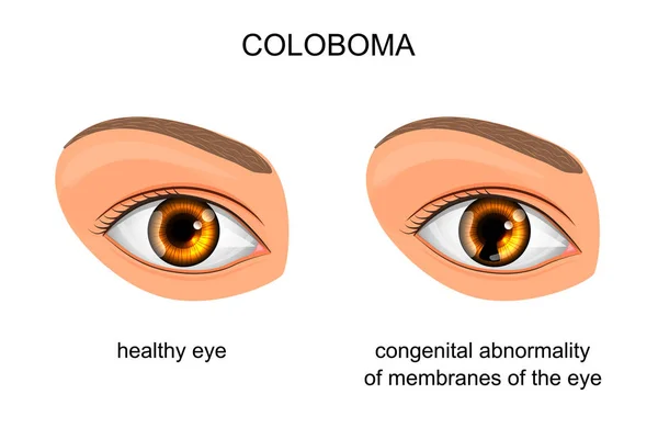 Distúrbio congênito das membranas do olho. coloboma — Vetor de Stock