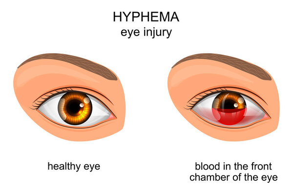 trauma to the eye. hyphema.