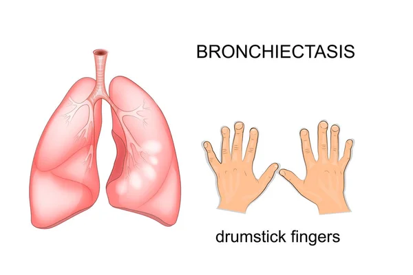 The patient's lungs bronchiectasis disease. fingers like drum st — Stock Vector