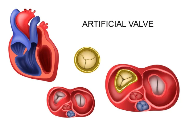 Protetiska tricuspid hjärtklaff — Stock vektor