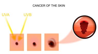 cancer of the skin. Oncology clipart