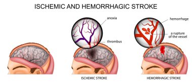 ischemic and hemorrhagic stroke clipart